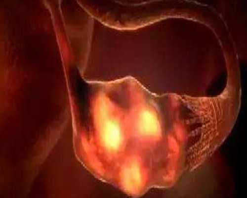 慢性宫颈炎和宫颈糜烂是一回事吗？还是递进关系？,供卵代生价格