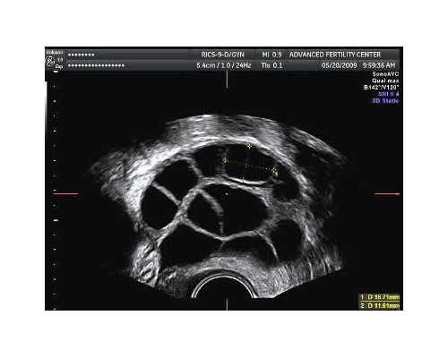 广州供卵自怀费用明细,广州供卵试管婴儿哪家好-公立代怀公司